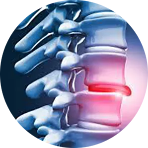 Disc Injury Treatment Chiropractor in Woodstock, GA Near Me Disc Injury Diagram